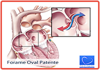 4-Forame Oval Patente-artigo