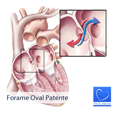 forame-oval-patente