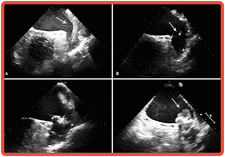 Ecocardiografia Transesofágica