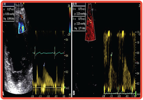 Análise de Fluxo Coronariano
