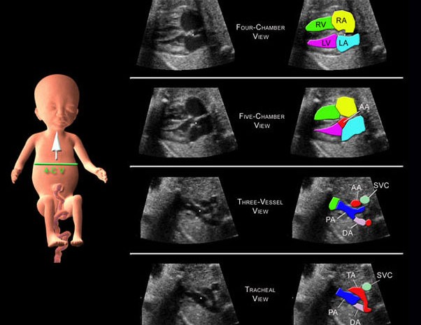 ecocardiograma-fetal