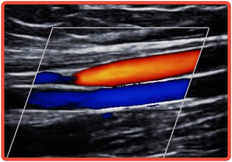 Ecodoppler Arterial e Venoso de Membros Superiores e Inferiores